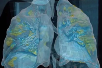 美国医院VR影像展示新冠肺炎患者肺部，肺损伤或长期遗留